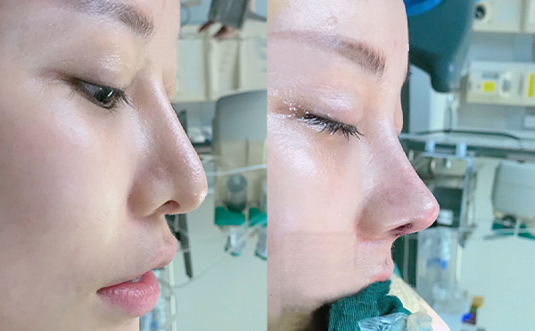 隆鼻失敗的原因是什么？隆鼻修復(fù)方法有哪些？