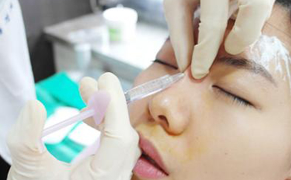 玻尿酸隆鼻大概要花多少錢？能維持多久？