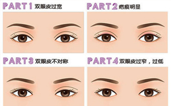 雙眼皮失敗有哪些明顯表現(xiàn)？修復成功率大嗎？