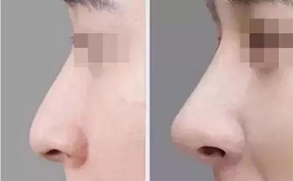 隆鼻前應(yīng)該做什么準(zhǔn)備確保有好的手術(shù)效果？