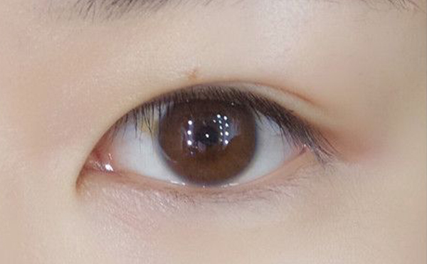 內雙怎么才能變成雙眼皮?效果好嗎?