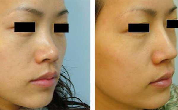 隆鼻手術(shù)有沒有什么后遺癥？