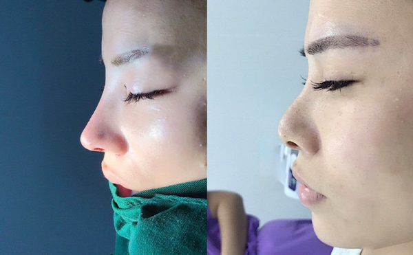 做隆鼻手術(shù)需要滿(mǎn)足什么條件？月經(jīng)期間可以做隆鼻手術(shù)嗎？