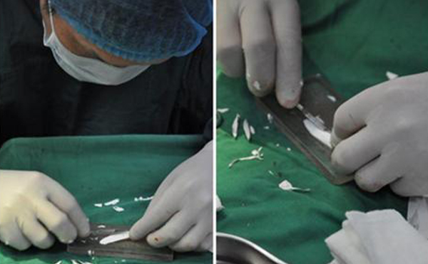 做隆鼻手術(shù)疼不疼？