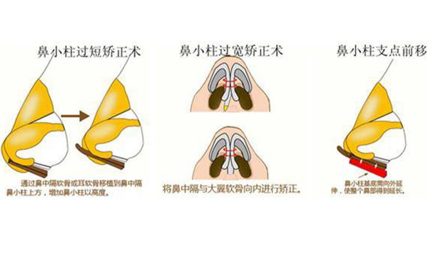 鼻小柱缺損修復(fù)有幾種方法？為什么會(huì)出現(xiàn)鼻小柱缺損的情況