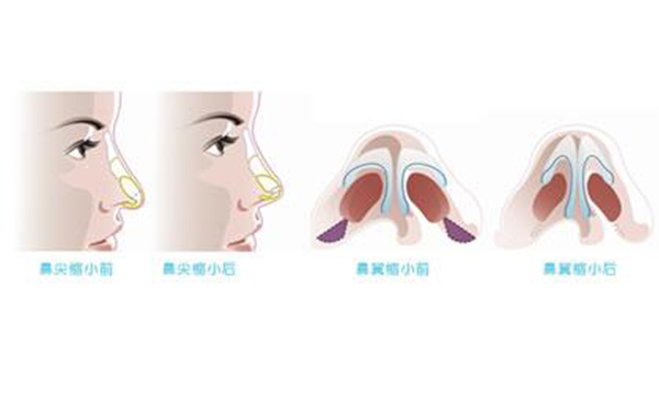 鼻翼縮小整形安全嗎？術(shù)后會(huì)不會(huì)影響呼吸