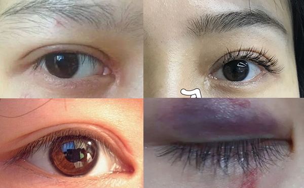 開(kāi)內(nèi)眼角容易留疤嗎?開(kāi)內(nèi)眼角危害大不大?