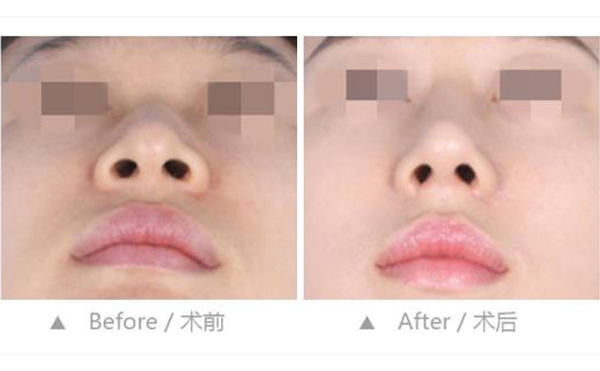 鼻孔縮小整形是怎么做的？效果好不好？