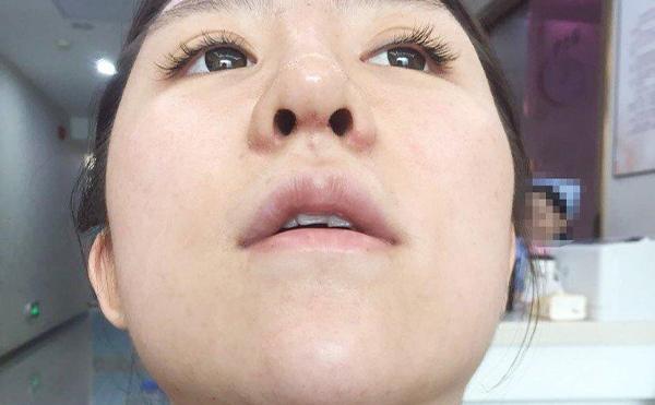 有沒(méi)有不做手術(shù)讓鼻孔縮小的方法?捏鼻子有用嗎?