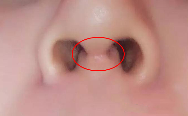 假體隆鼻的切口會不會留下疤痕?