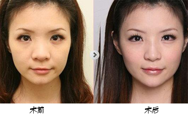 為保證鼻頭肥大矯正手術(shù)效果，術(shù)前術(shù)后應(yīng)該注意些什么？