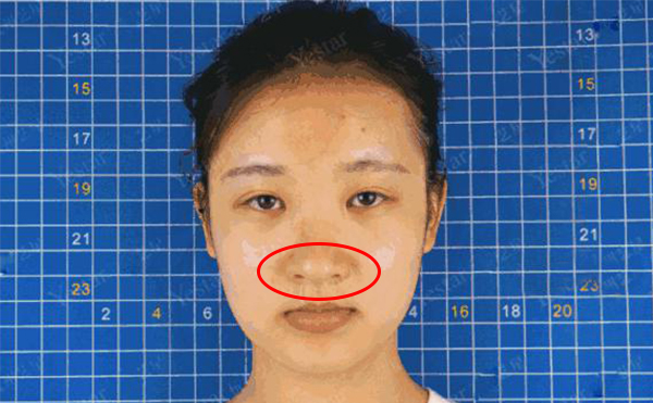 鼻頭肥大是什么原因造成的？怎么解決鼻頭肥大