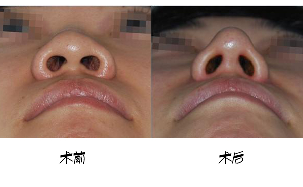 鼻小柱延長手術(shù)的大致流程是什么？手術(shù)成功率高嗎