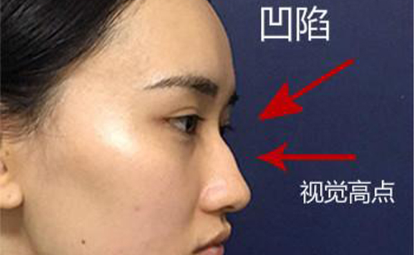 駝峰鼻整形是怎么做的？不同嚴重程度的駝峰鼻矯正方法一樣嗎？