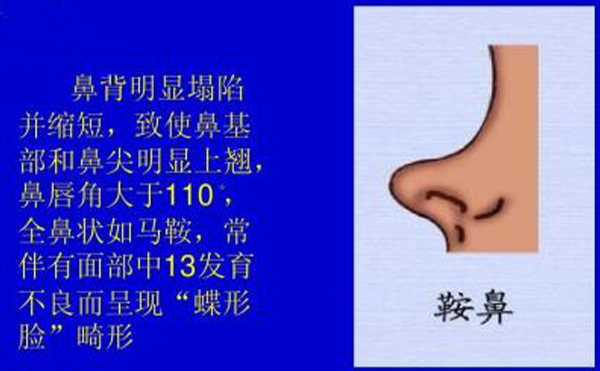 鞍鼻長(zhǎng)什么樣子?哪些人需要做鞍鼻矯正手術(shù)?
