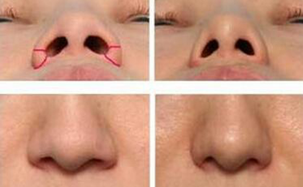 哪些人適合做鼻孔縮?。恳话銜檬裁捶椒▉磉_(dá)到縮小鼻孔的目的