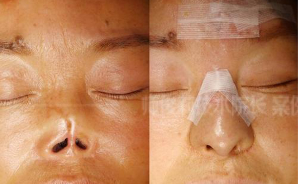 全鼻再造手術(shù)是怎么做的?效果怎么樣?
