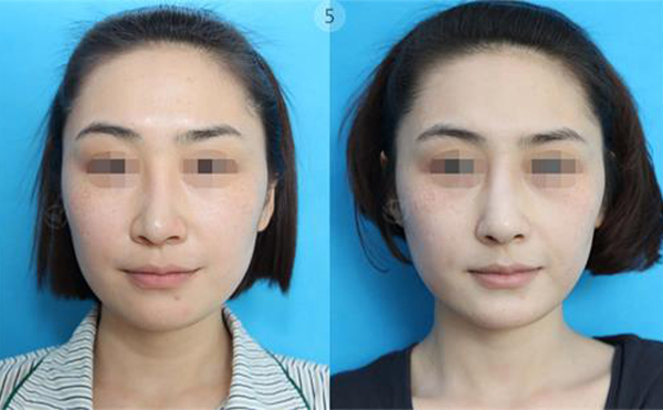 做歪鼻矯正手術(shù)大概需要多少錢(qián)?受哪些方面影響?