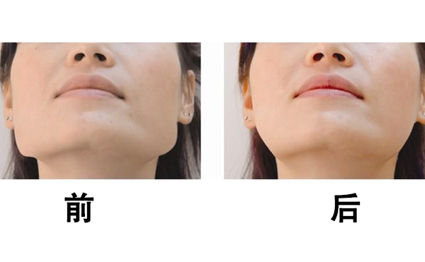 哈爾濱斯美諾做下頜角怎么樣?