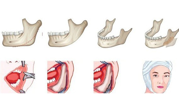 哪些人不能做下頜角切除手術(shù)？