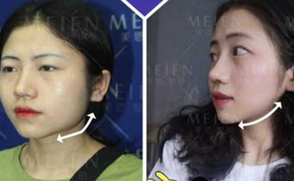 下頜角整形遠(yuǎn)沒有你想的那么安全，風(fēng)險不是一般的大