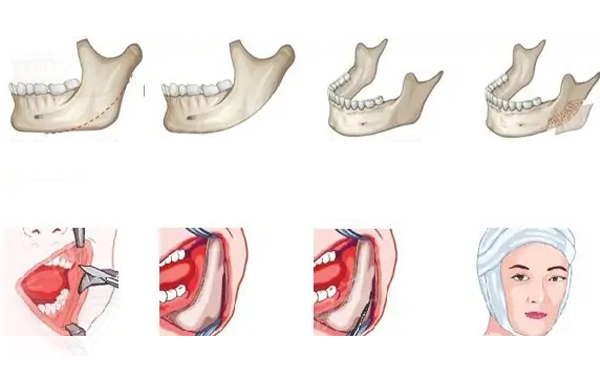 下頜角手術(shù)是在哪里切口?有幾種切口方式?