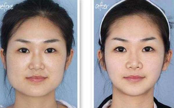 下頜整形術(shù)后護理