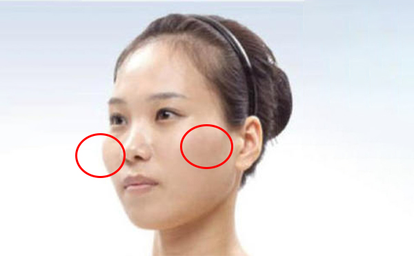 一般顴骨整形手術(shù)選擇哪個切口?