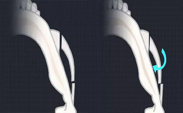 顴骨內(nèi)推是什么？