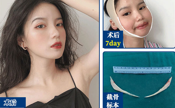 磨骨整形術后注意事項