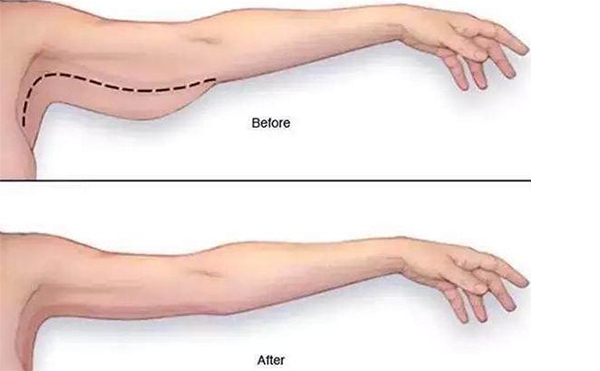 手臂吸脂需要多長(zhǎng)時(shí)間恢復(fù)？
