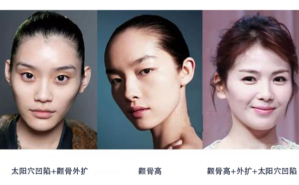 怎么區(qū)分是顴骨高還是太陽穴凹陷？