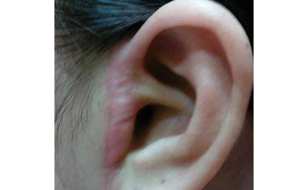 拉皮痕跡明顯嗎？