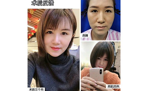 電波拉皮除皺的步驟是什么？