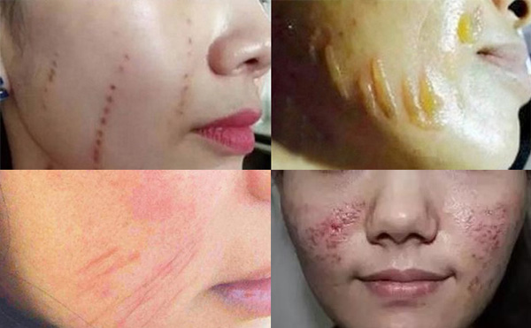 超聲刀有副作用嗎？