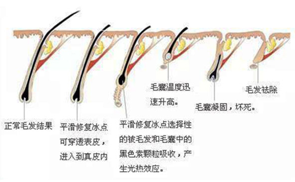 面部冰點(diǎn)脫毛會(huì)反彈嗎?不到半年又長了是怎么回事?