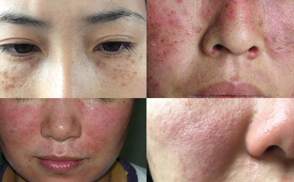 激光脫毛有風險嗎？