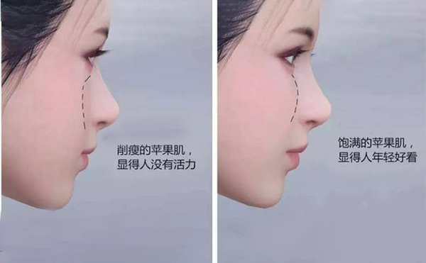 蘋果肌凹陷怎么辦？