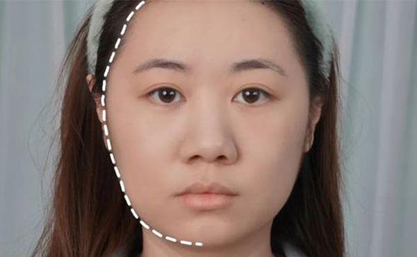 大臉改小臉整形怎么做？