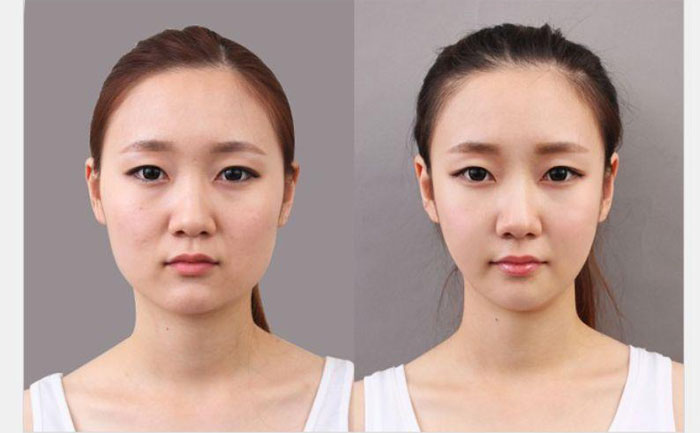 非手術(shù)瘦臉多少錢(qián)？非手術(shù)瘦臉?lè)椒ㄓ心男? data-mce-src=