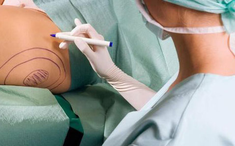 無(wú)痛吸脂是怎么做的？無(wú)痛吸脂手術(shù)價(jià)格是多少？