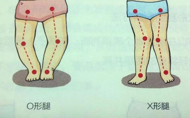 羅圈腿怎樣矯正？羅圈腿手術(shù)矯正多少錢？