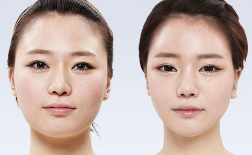 顴骨整形要多少錢？