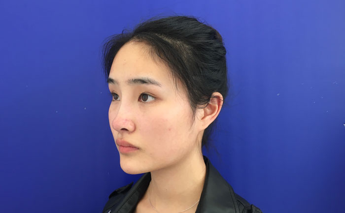 墊下巴一般多少錢？