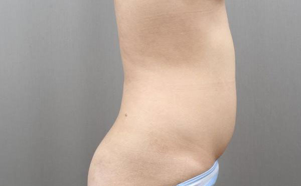 腹部吸脂手術(shù)價(jià)格是多少？腹部吸脂手術(shù)的副作用？