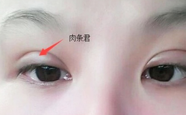 雙眼皮不自然怎么補救？雙眼皮肉條好修復(fù)么？