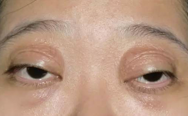 如何區(qū)分腫泡眼和眼球突出?術(shù)前檢查過(guò)程?