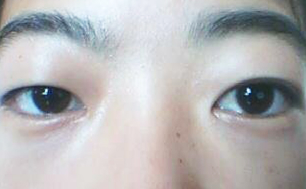 間歇性眼球突出是什么意思?眼球突出矯正費(fèi)用受什么影響?