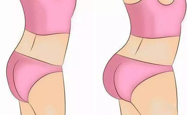 自體脂肪豐臀需要多次注射嗎?術后怎么護理?