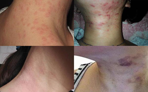 嗨體去頸紋有什么副作用？